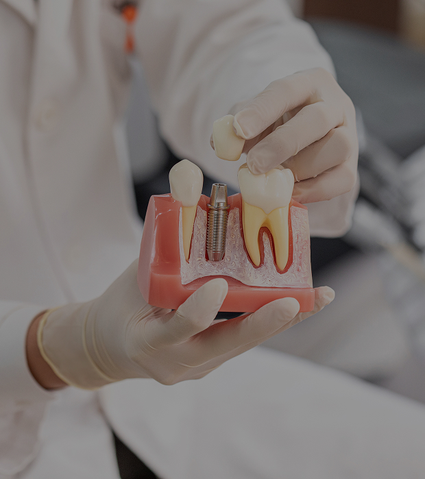 임플란트 관련 이미지