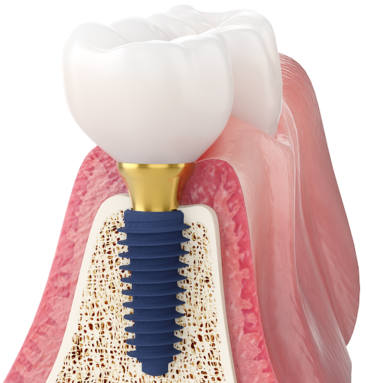 임플란트 치아 사진