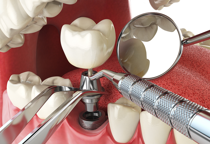 임플란트 시술 사진