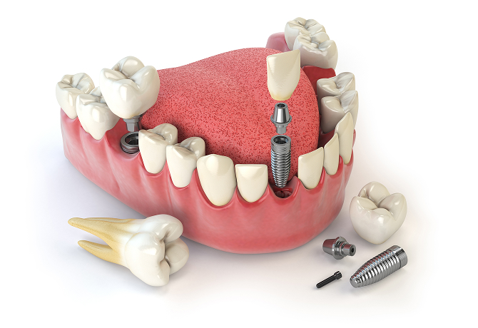 임플란트 시술 사진