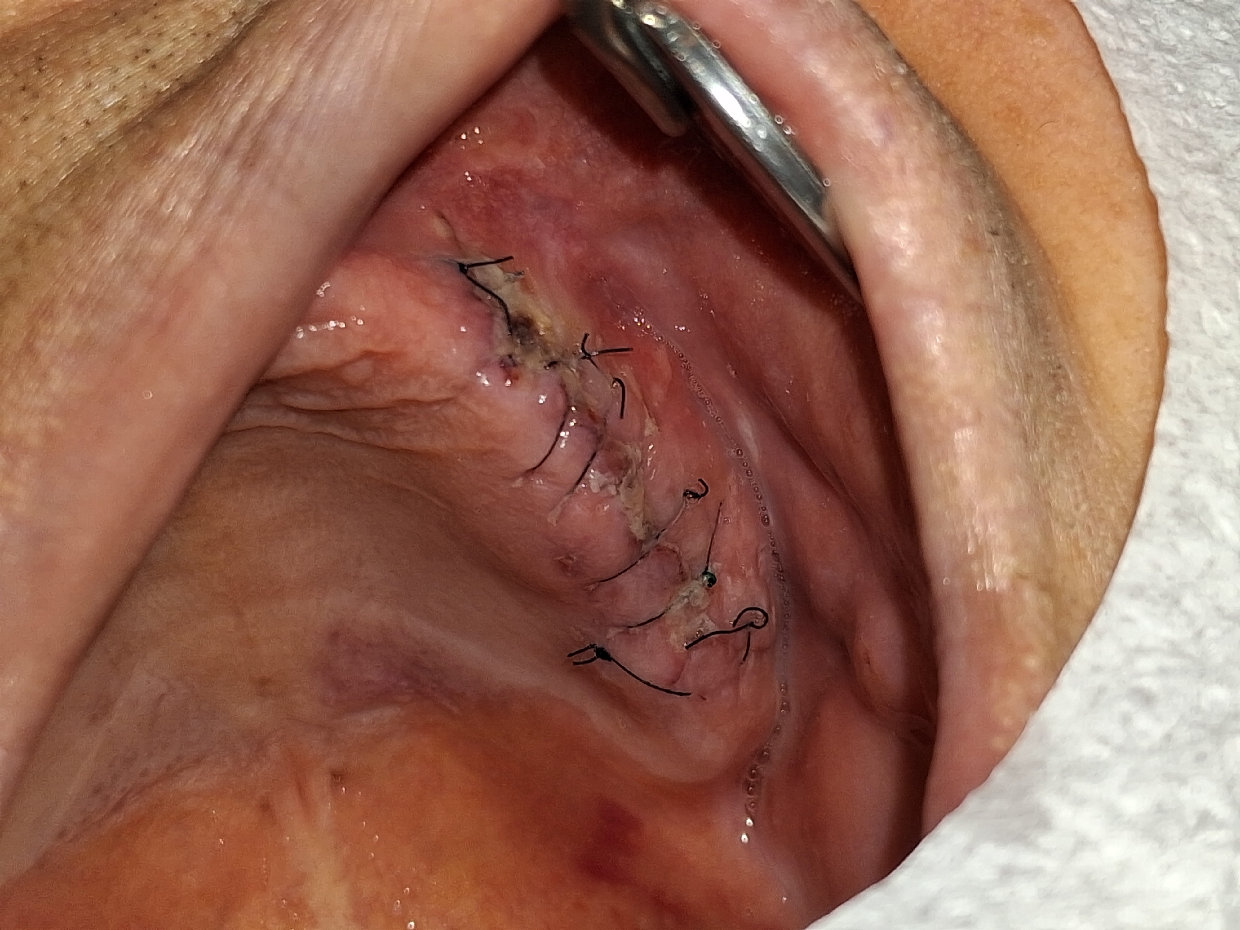 임플란트+엑소좀 썸네일