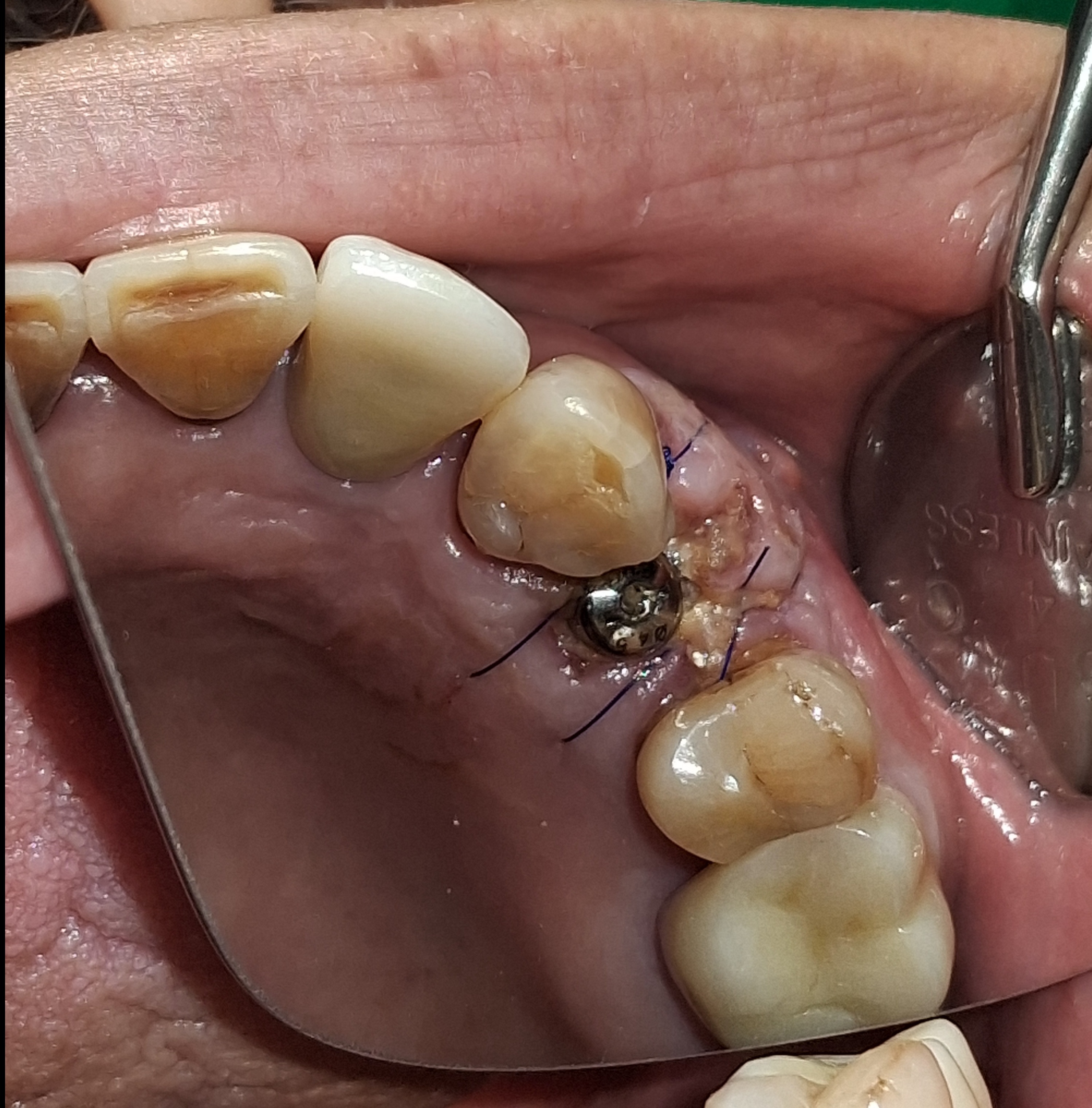 임플란트+엑소좀 썸네일