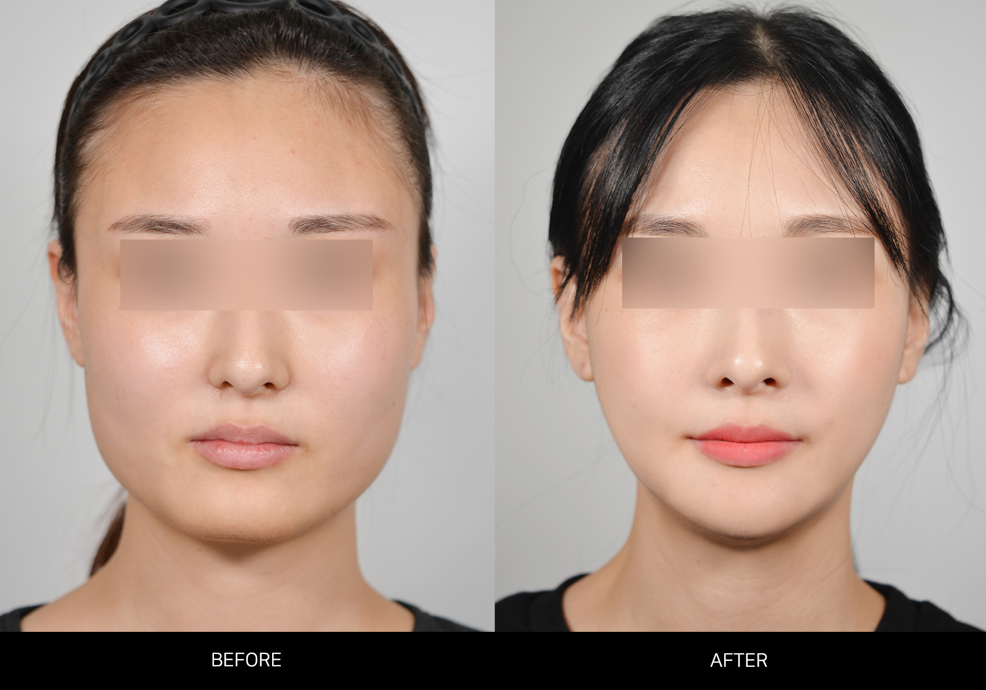 안면윤곽수술 (광대+사각턱+턱끝) 썸네일