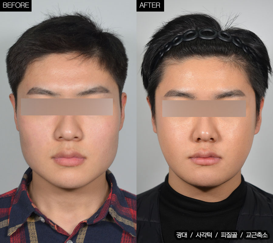 안면윤곽수술 (광대+사각턱+교근축소) 썸네일