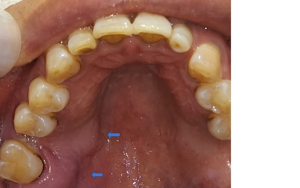 엑소좀-염증치유 썸네일