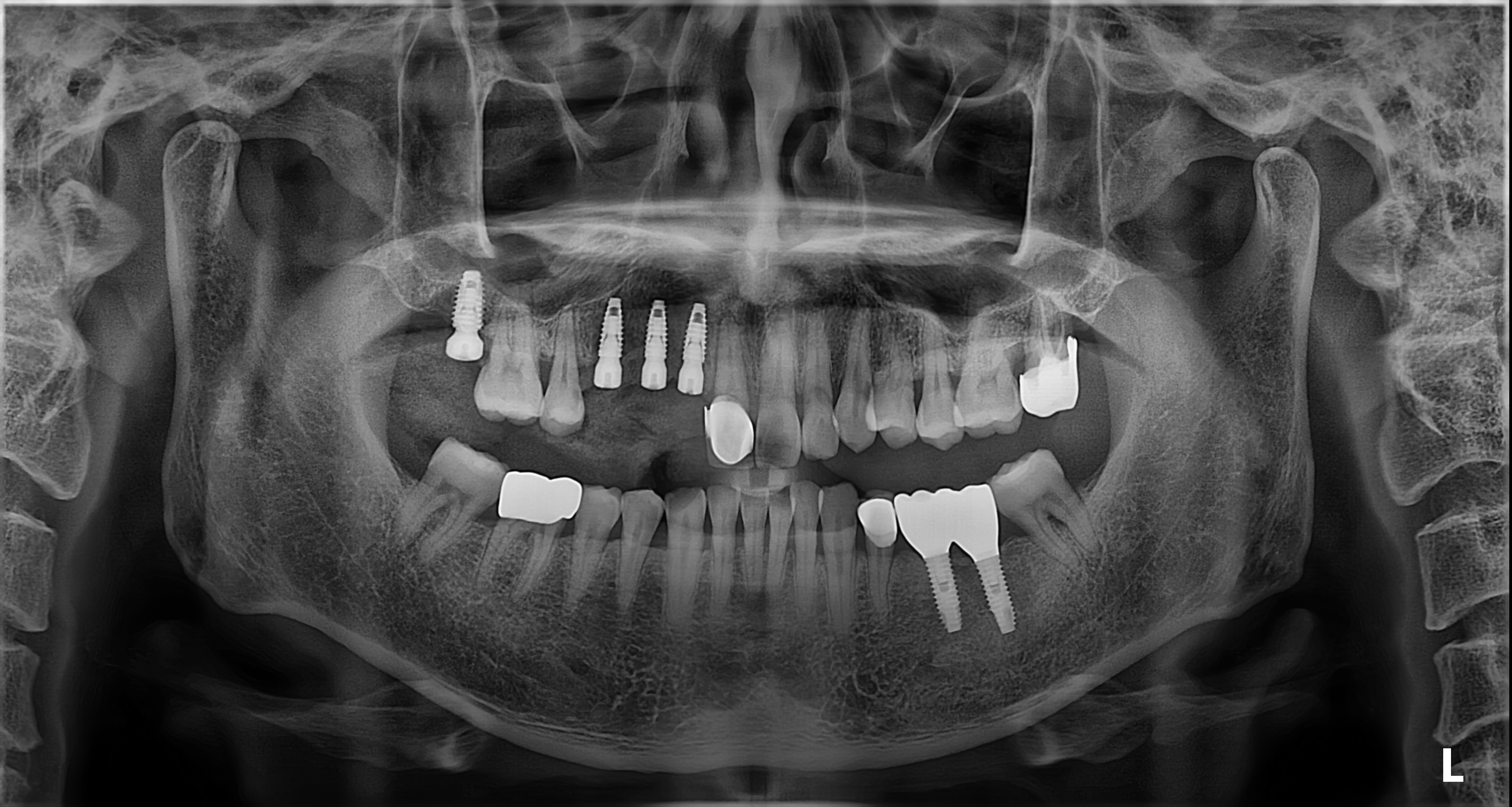 엑소좀+임플란트 썸네일