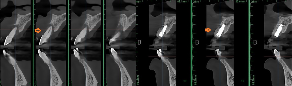임플란트+엑소좀 썸네일