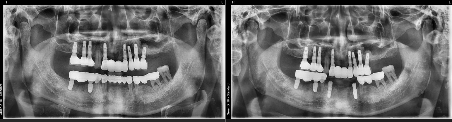 염증있는 치아 임플란트 썸네일