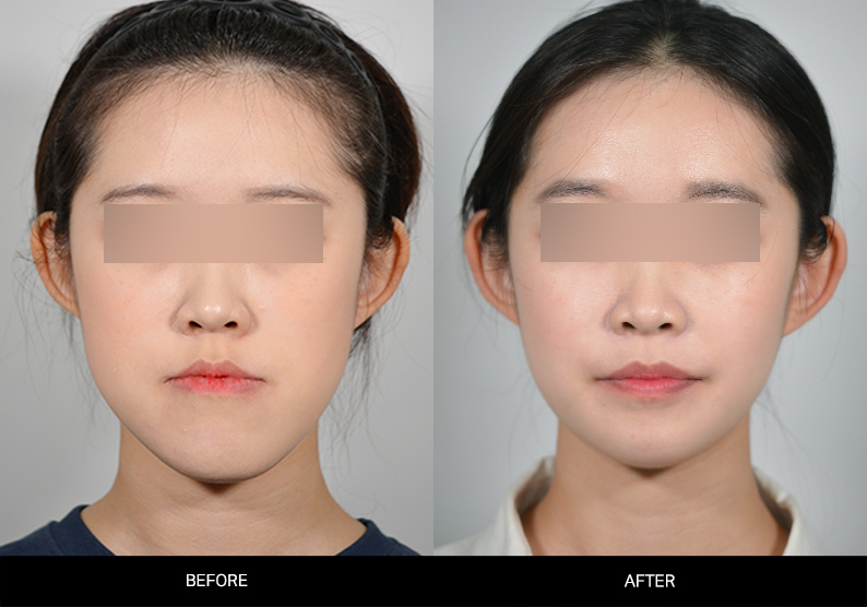 양악수술+턱끝수술 썸네일