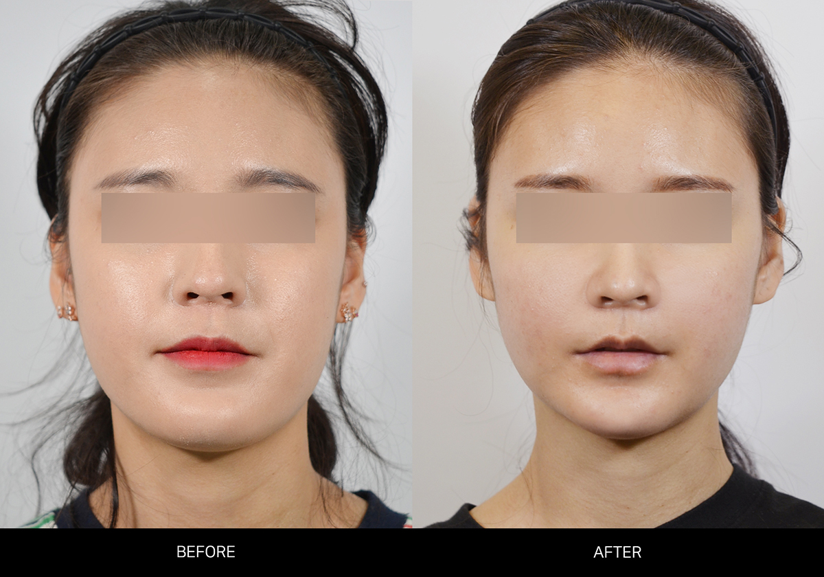 양악수술 썸네일