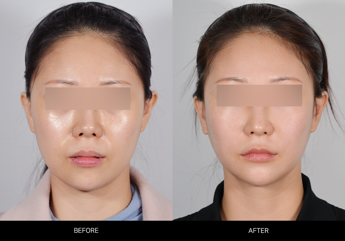 돌출입 양악수술 썸네일