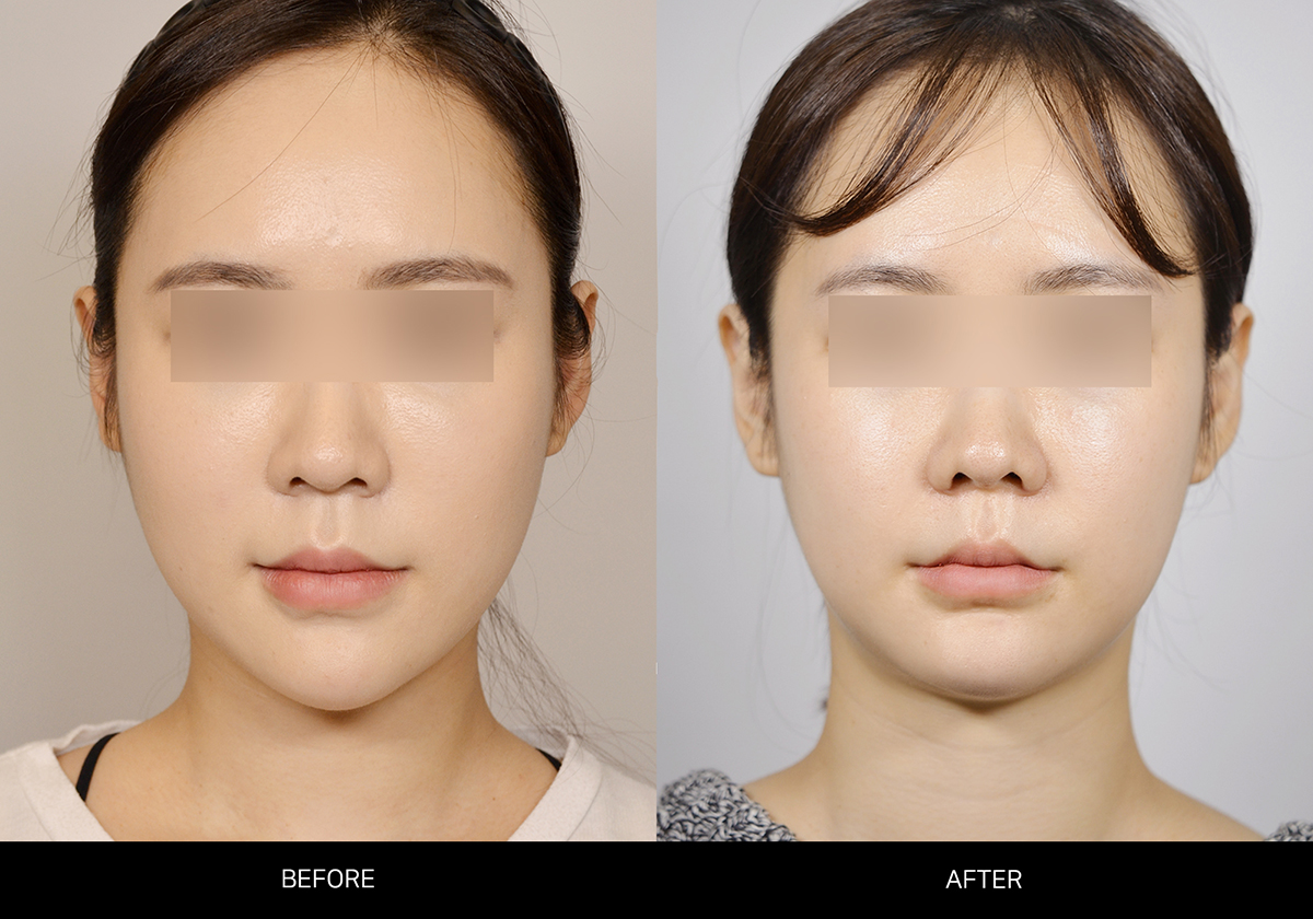 긴얼굴 양악수술 썸네일