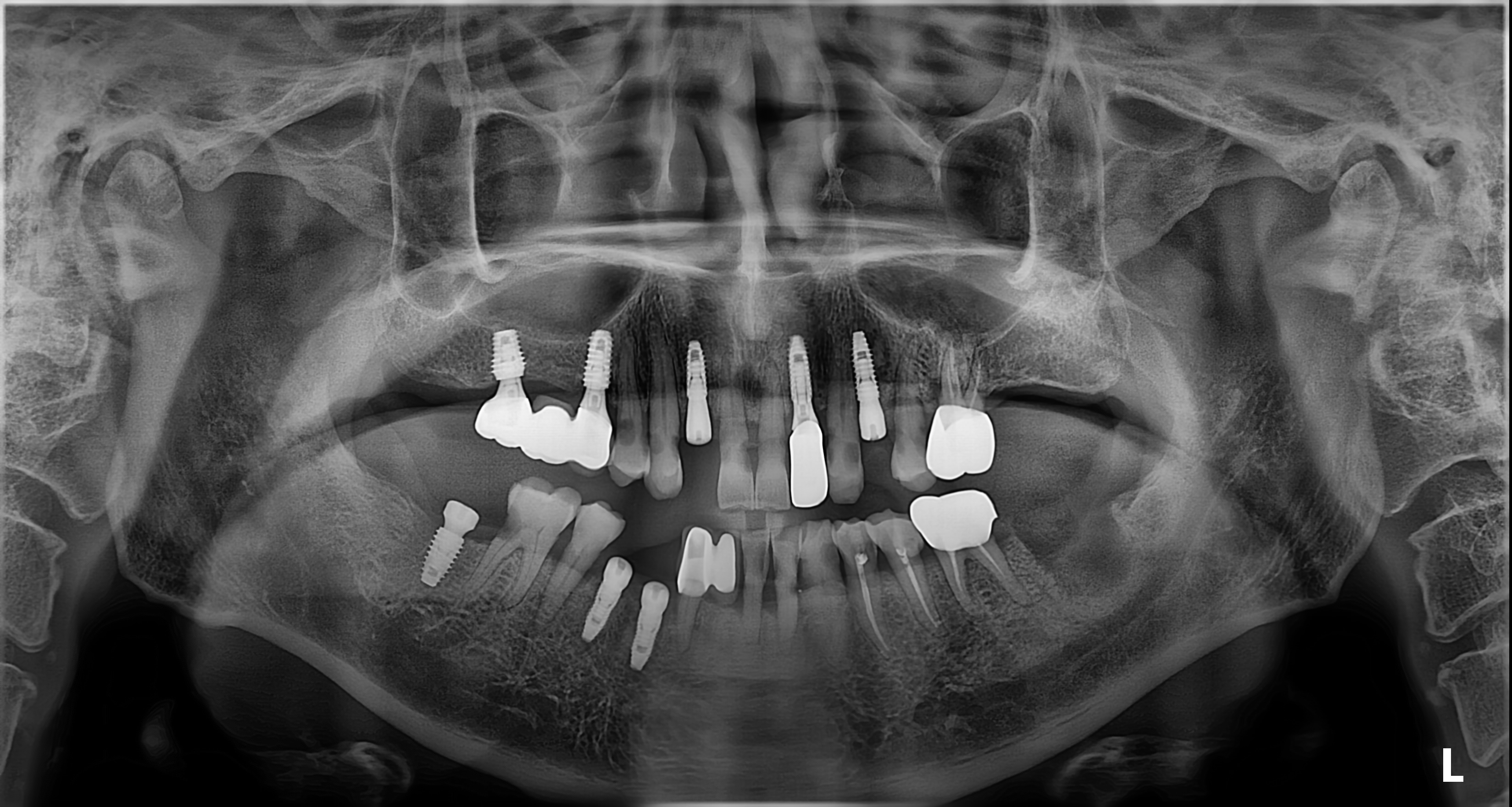임플란트+엑소좀 썸네일