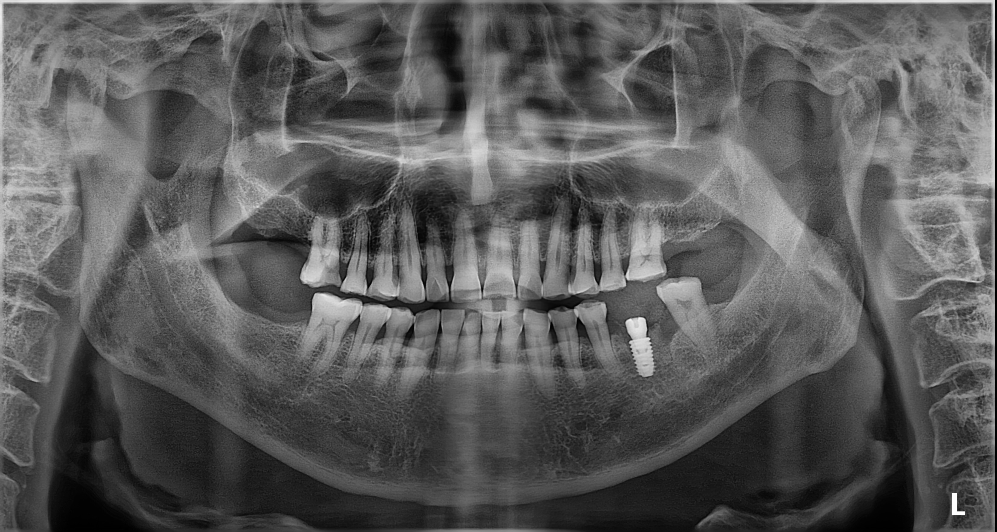 임플란트+엑소좀 썸네일