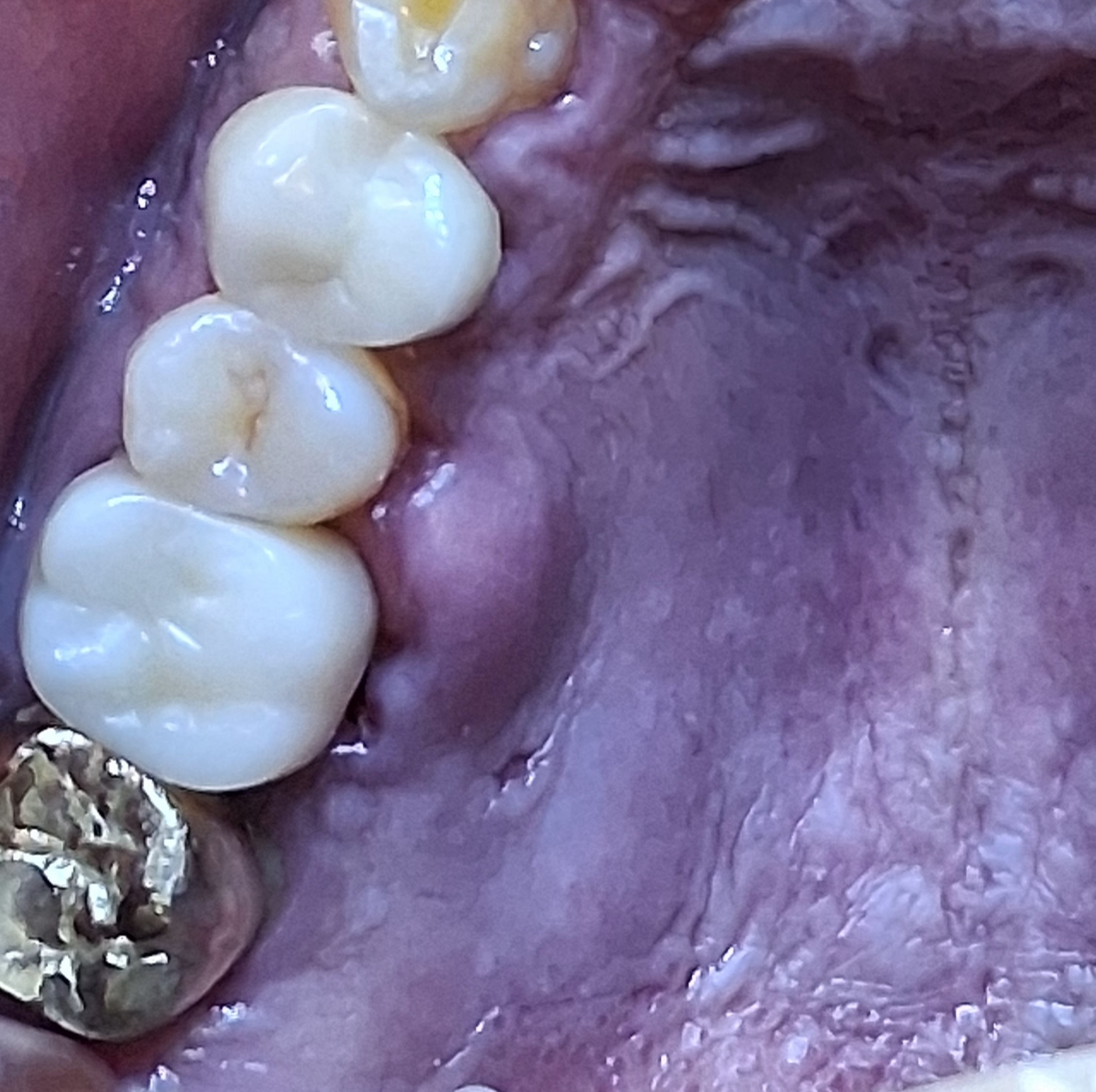 엑소좀이 염증에 미치는 효과 썸네일