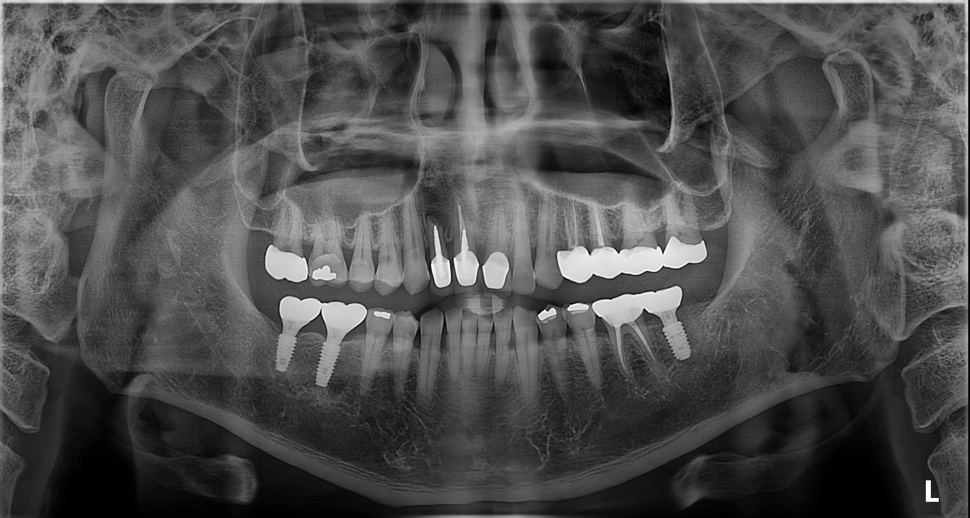 임플란트+엑소좀 썸네일
