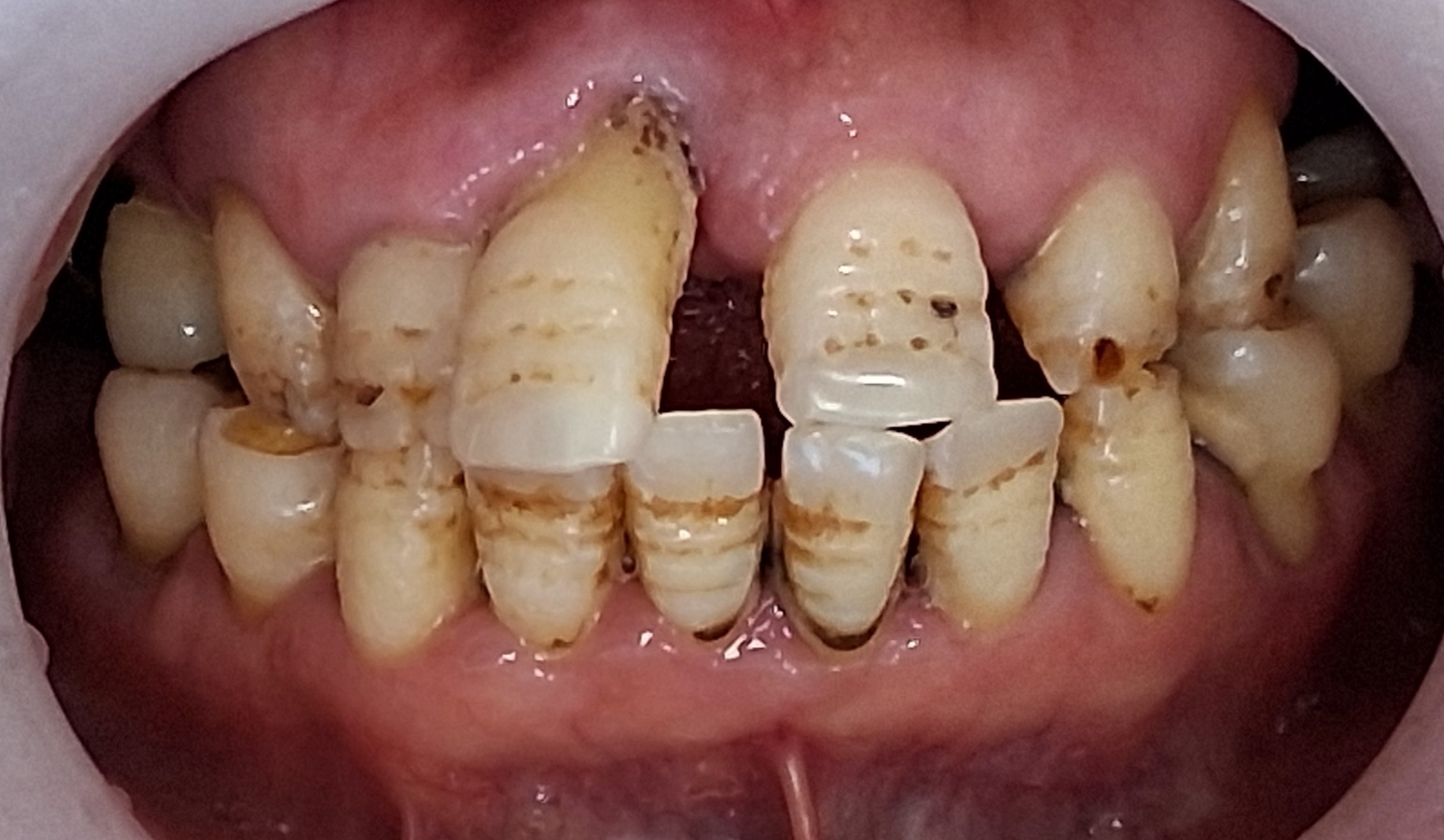 임플란트+엑소좀 썸네일