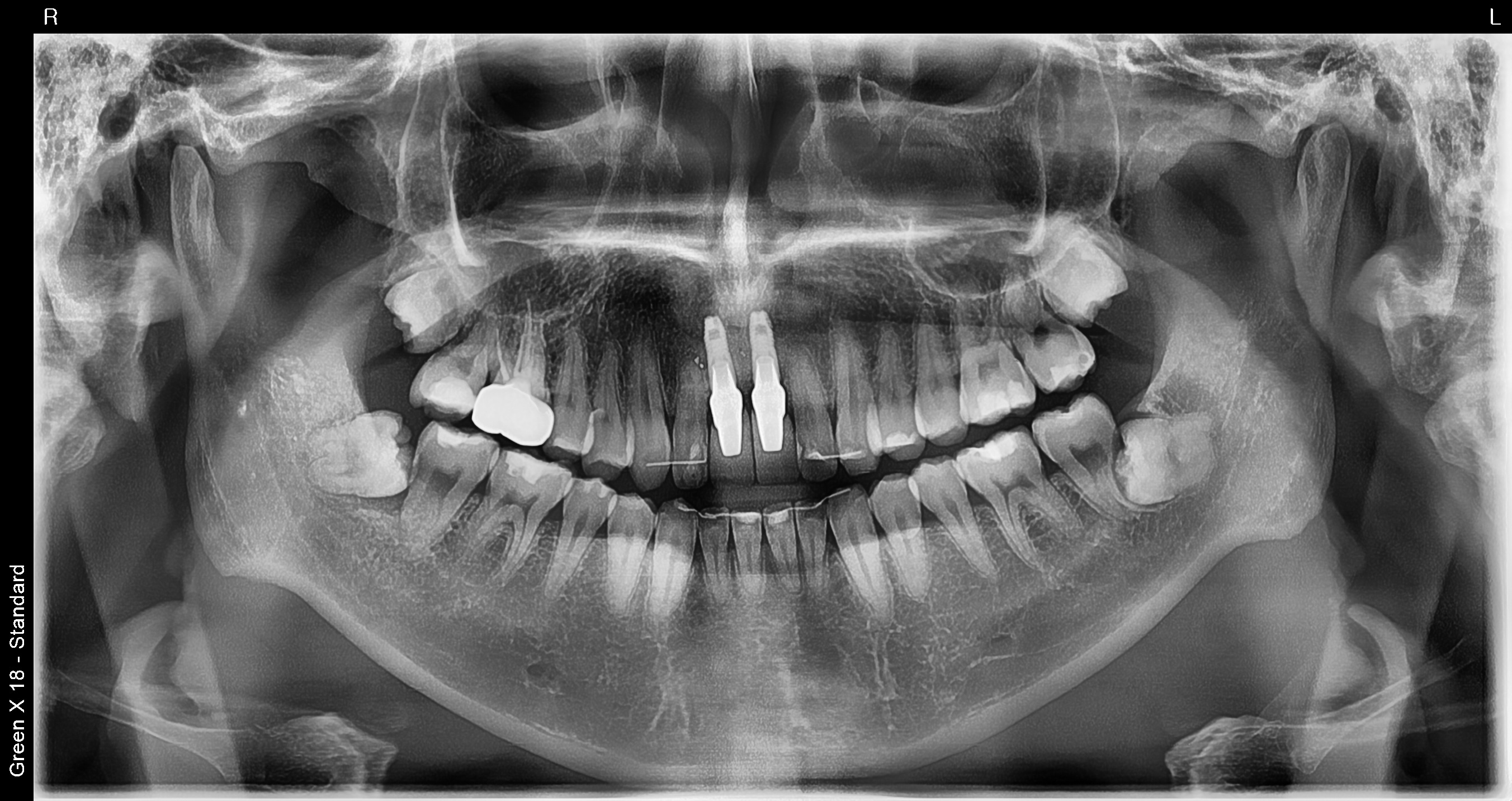 사랑니발치+엑소좀 썸네일