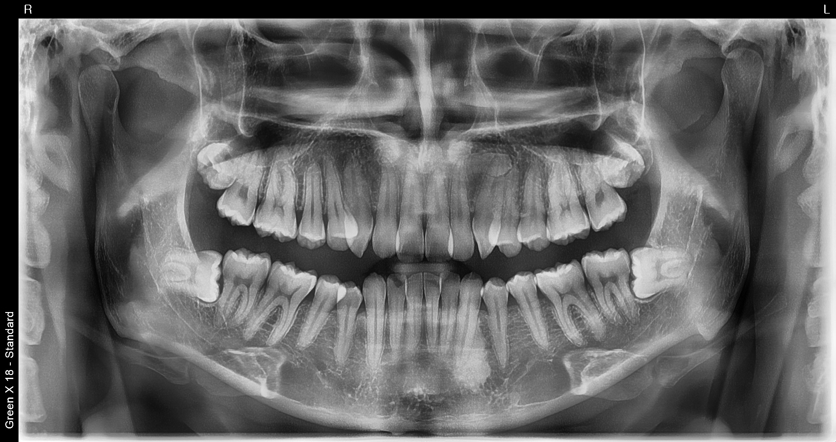 사랑니발치+엑소좀 썸네일